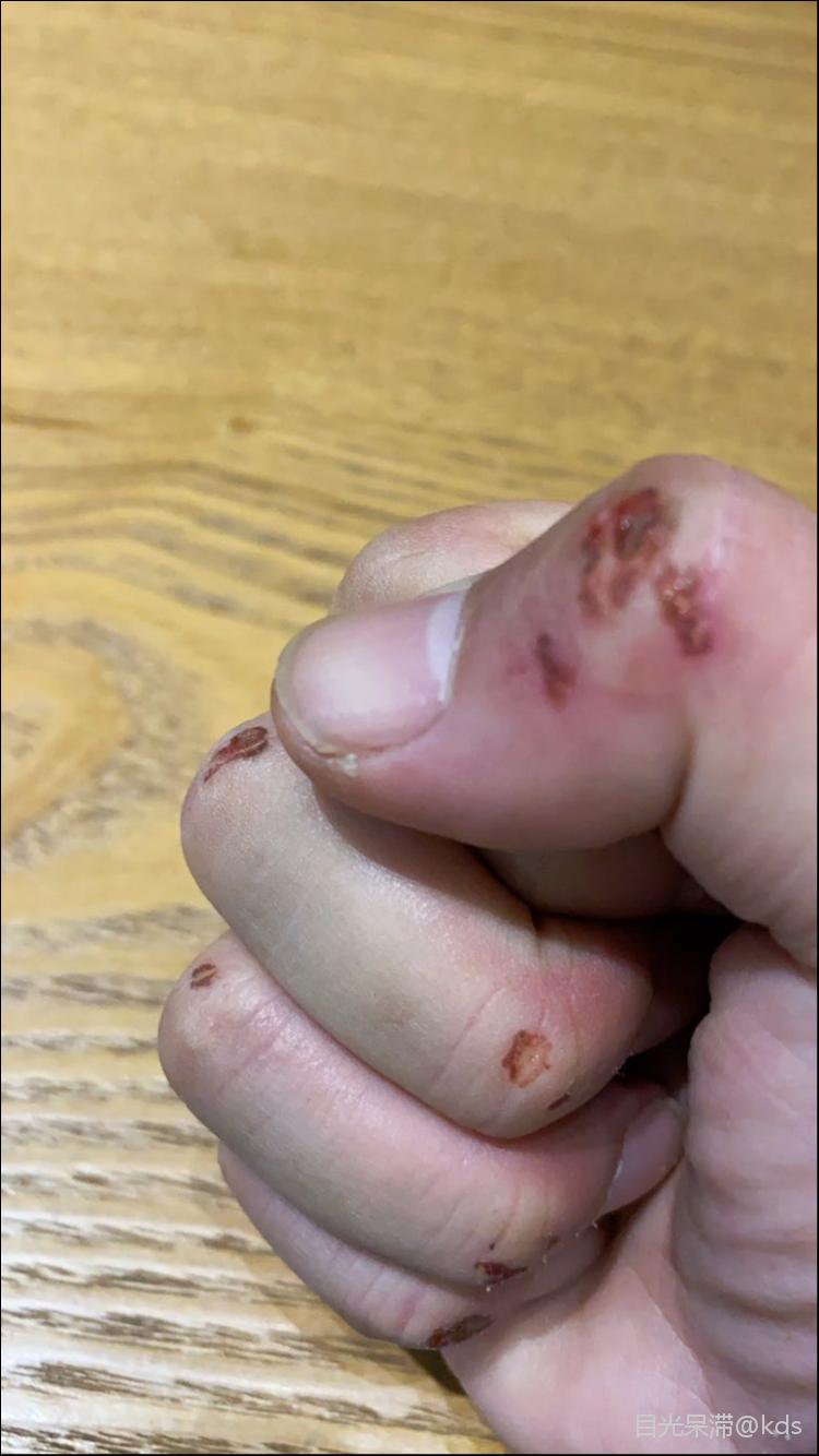 还手了,自己手都打烂了!无奈体力有限