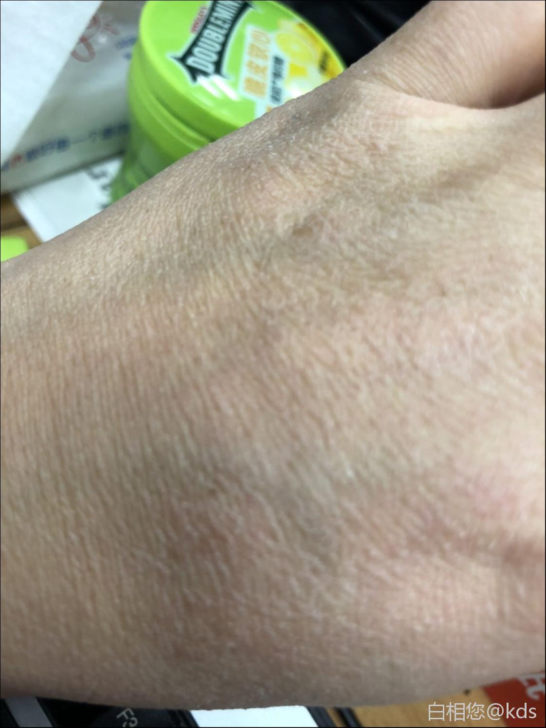 手背上的皮肤一夜之间变成这样了!