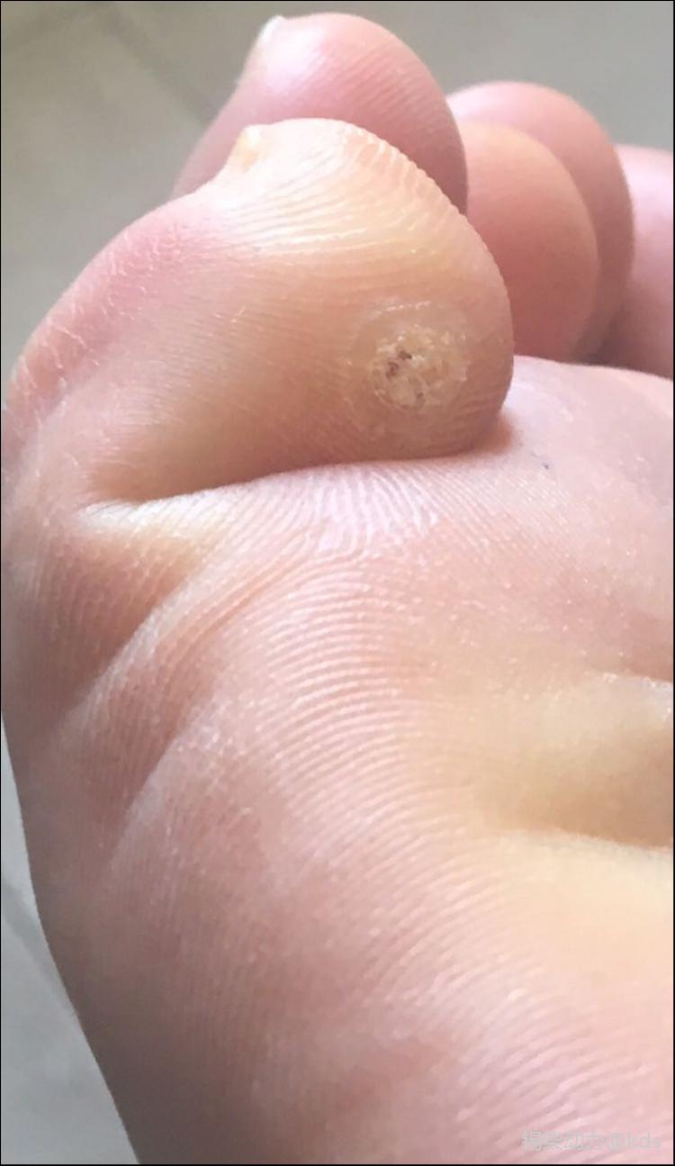 脚上长了一个,碰到有点疼