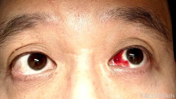 紧急求助刚用了1小时电脑莫名其妙突然眼内出血怎么办