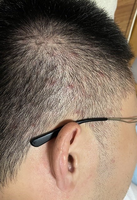 头皮上的红点有什么办法?