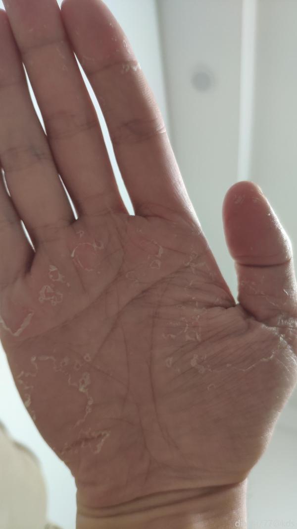 有人和我一样手蜕皮吗