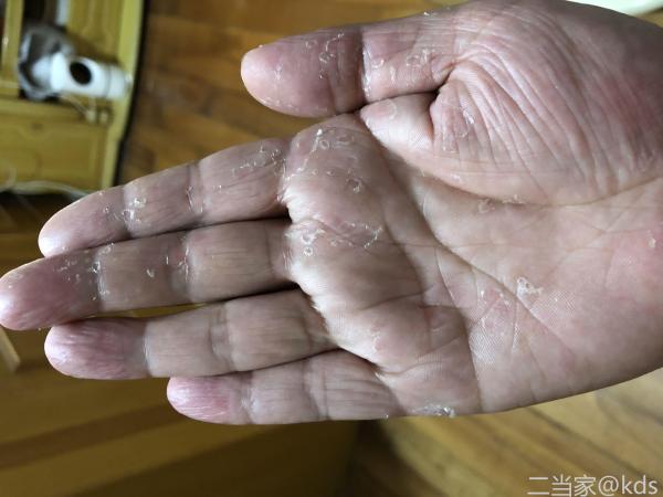 有人和我一样手蜕皮吗