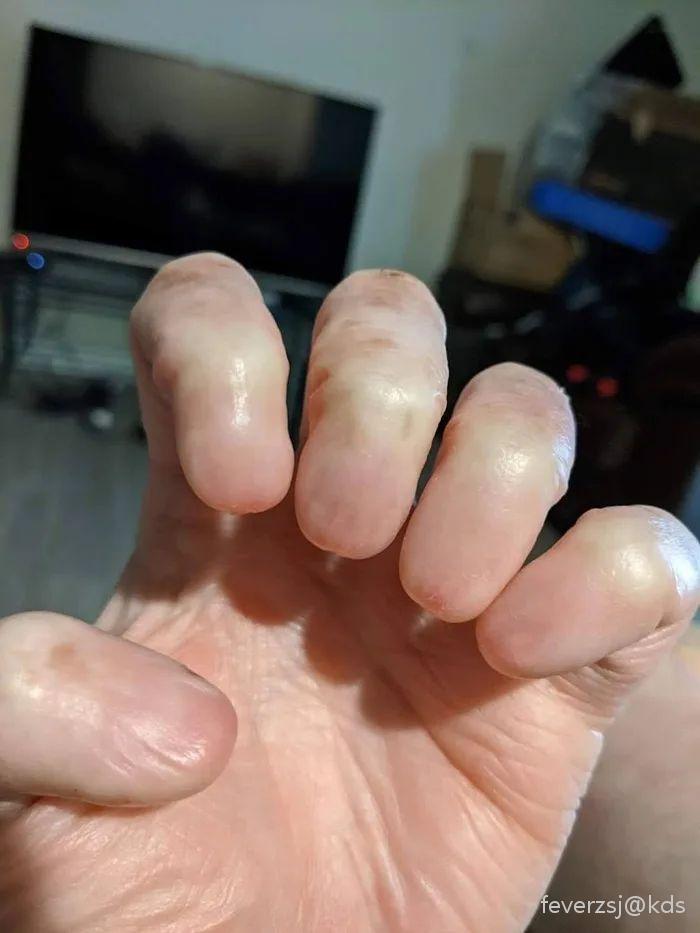 没有指甲是什么感受?