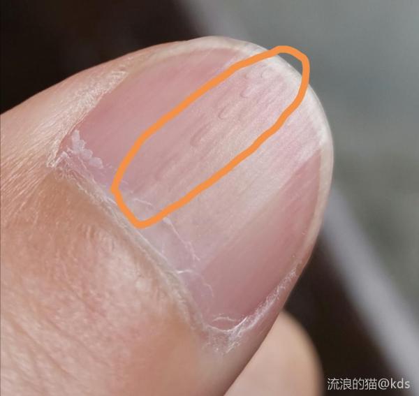 手指甲都是这种竖纹是什么原因?刚开始就一两个手指甲现在十个都有.
