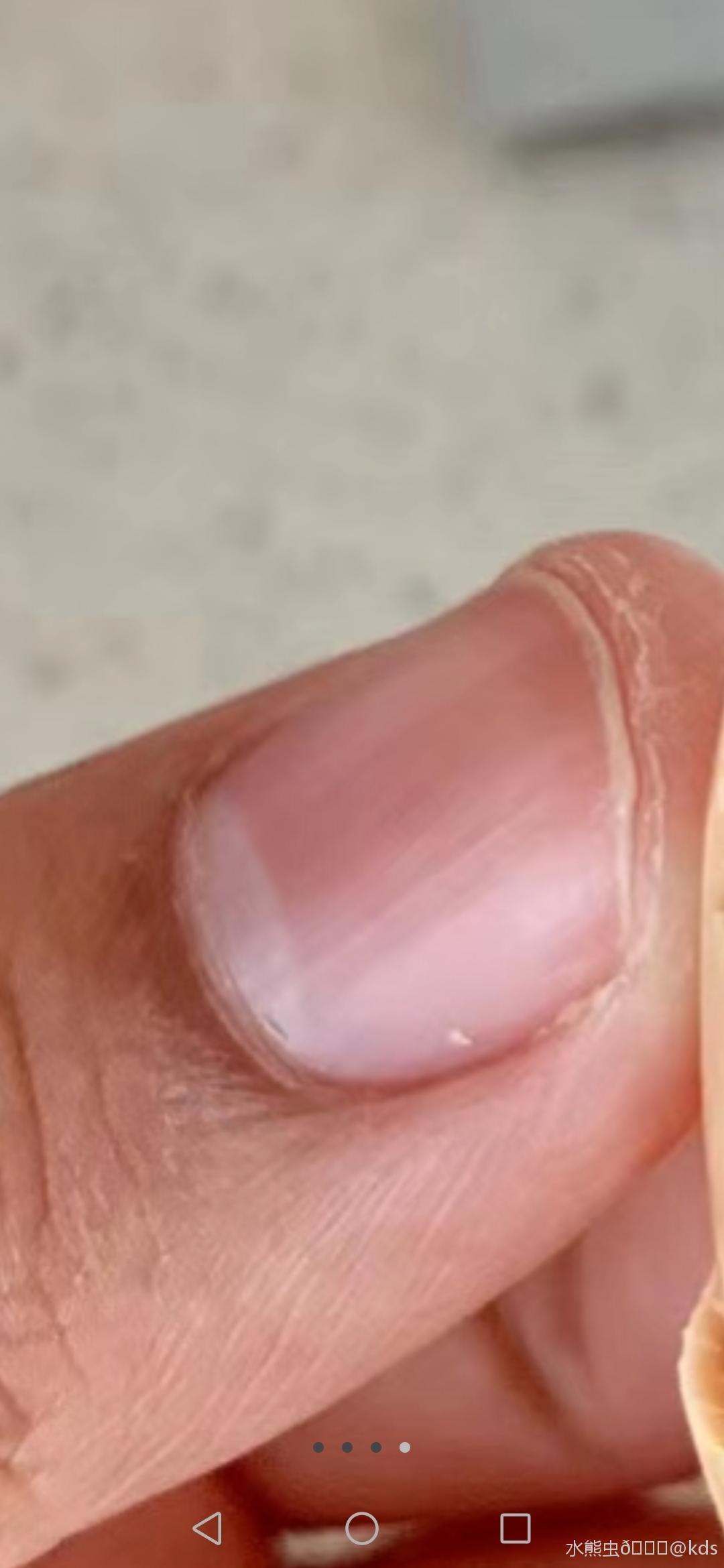 山上老中医看看这个指甲竖条