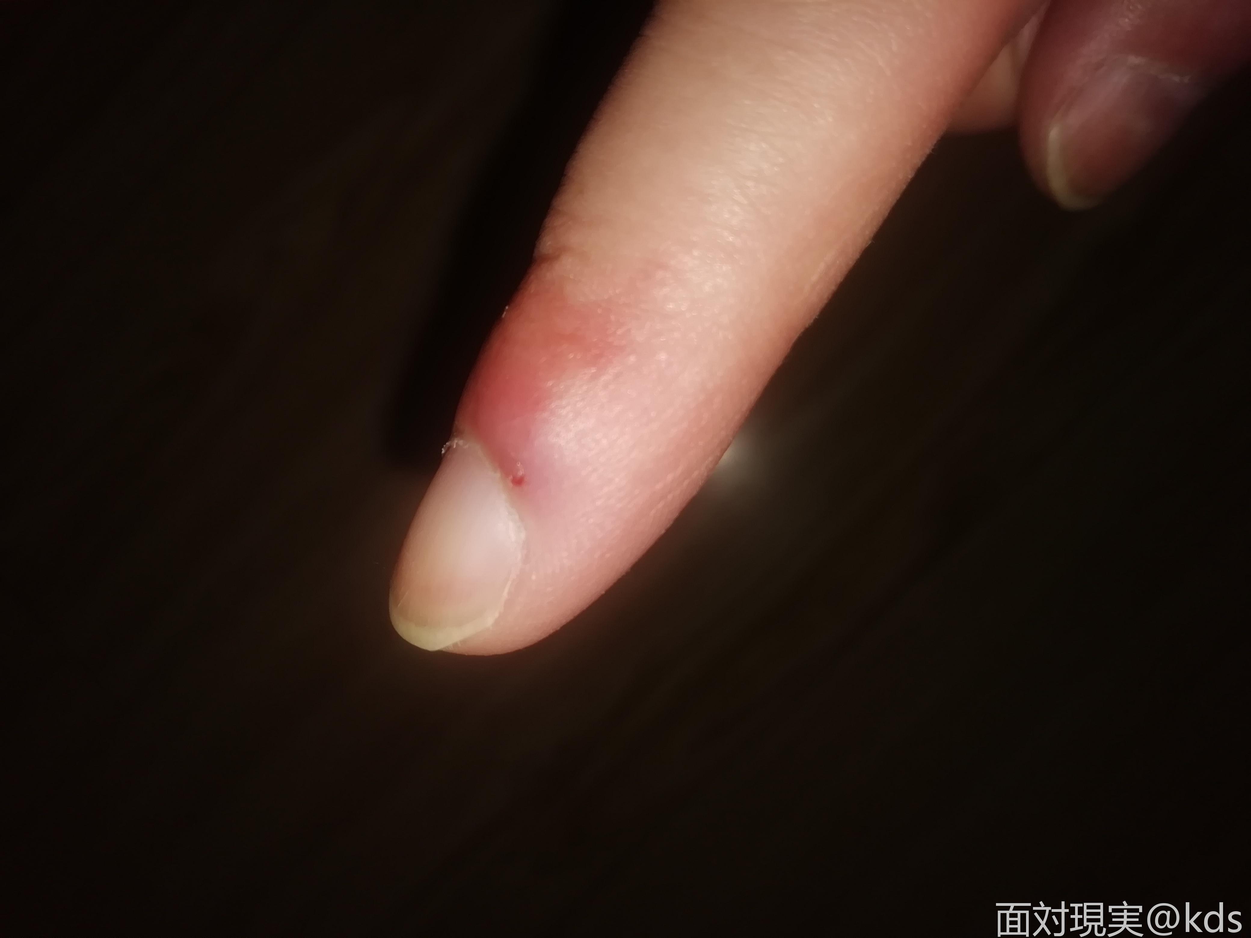 只是紫血泡 指甲骨头没碰到