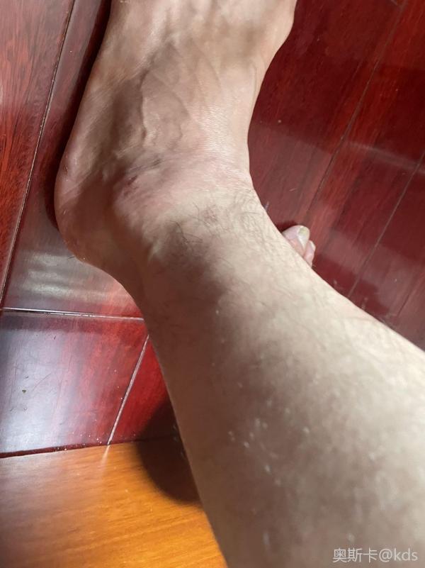 脚踝肿了半年了中医能看好么