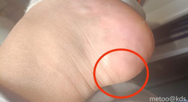 脚后跟这里按下去会痛