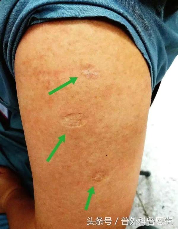 所以说80后都没有接种过牛痘病毒吧-宽带山kds-宽带山社区-城市消费